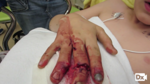 Acute onset, hand trauma with partial amputation of the middle finger