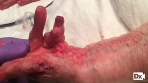 Amputation of distal fingertip from self-harm (bite injury)