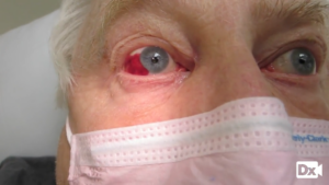Acute onset, red eye and cough